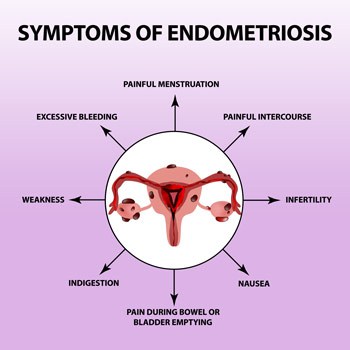 Symptoms of Endometriosis